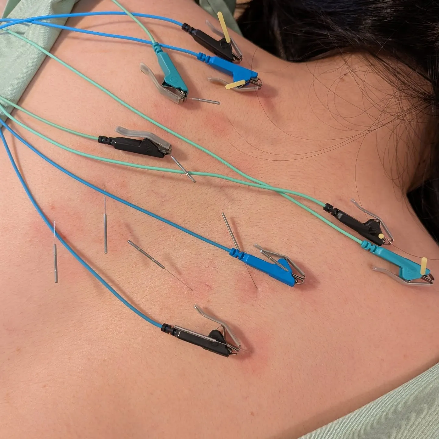 昨日はイベントスタッフとして毎日動かれているお客様が肩こり、...