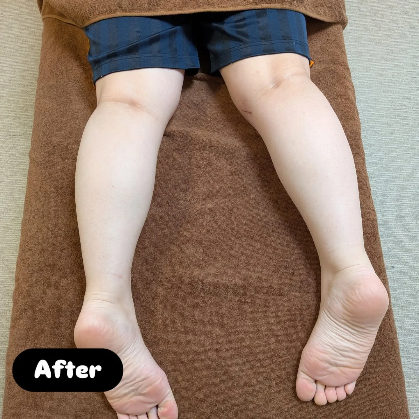 フットケアのビフォーアフターです。