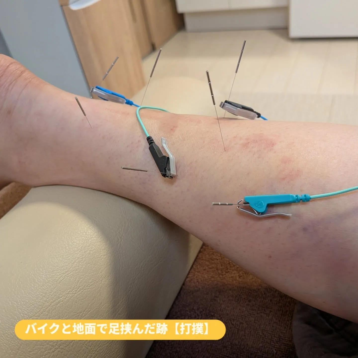 バイクで挟んだ足の打撲・むくみへの鍼通電治療】