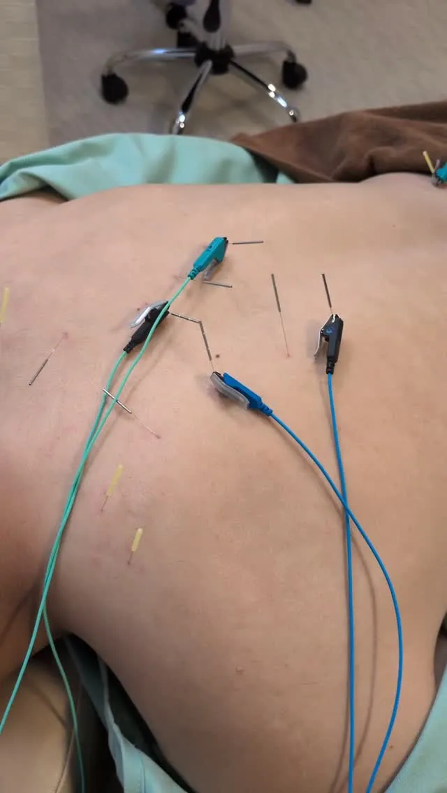 #鍼治療#肩こり#電気治療