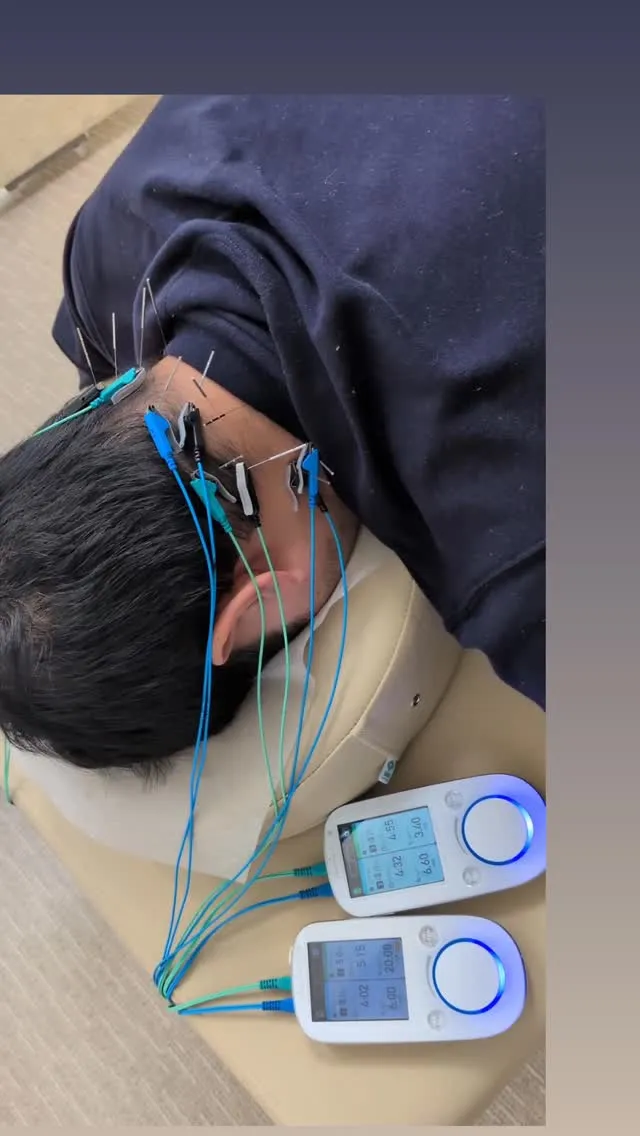#リラクゼーションサロンsheep #頭痛#鍼灸 #池袋